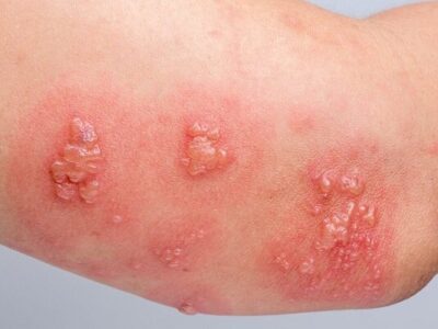 ویژگی‌های خاص واکسن زونا