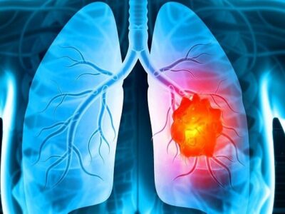 درمان تغییرات ایجادشده در میکروبیوم ریه بر اثر سیگار کشیدن