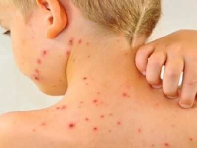 افزایش موارد ابتلا به سرخک در جهان با کاهش میزان واکسیناسیون